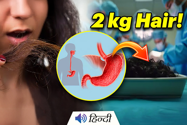 UP: Doctors Remove 2 kg Hairball From 21-Year-Old Girl’s Stomach